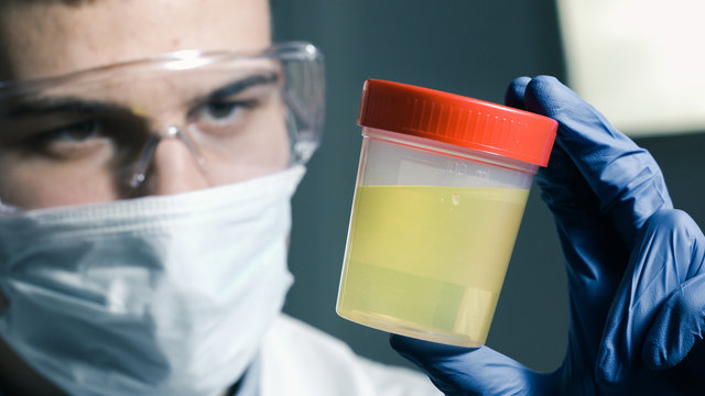 A Doctor Testing Urine Sample. Fresh Specimen In A Cup For Examining.