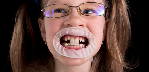 Little girl shows crooked teeth on a black background.