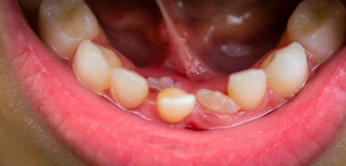 Second milk tooth moving just before falling out. It gets bloody.