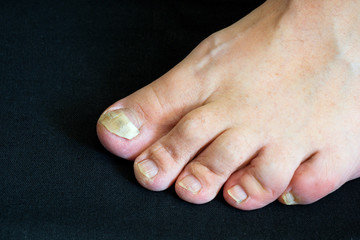 Toenail fungus on a black background . Fingernail peels off