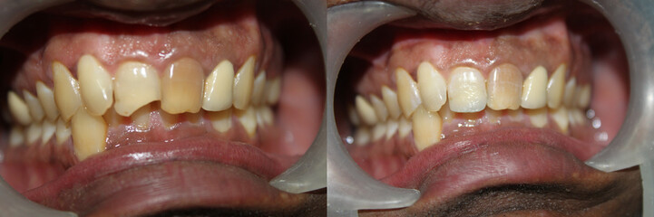 Fractured tooth restored with composites