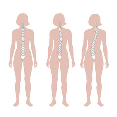 Scoliosis flat vector illustration