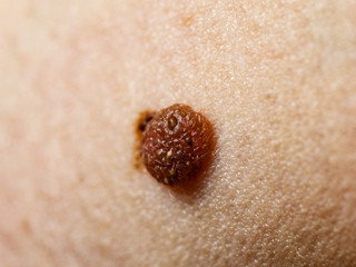 Closeup brown mole on skin.