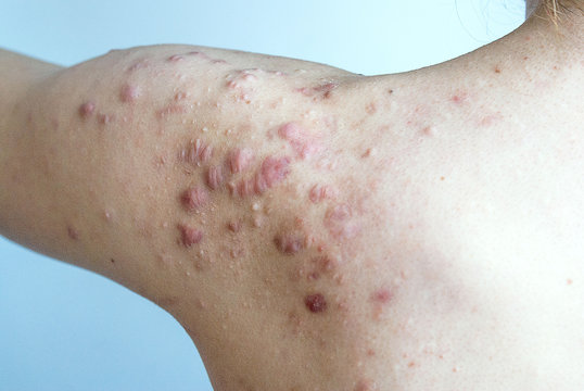 The young girl has many bright red keloids on her left shoulder.  problems and treatment of acne in young people.  Skin rashes. Problems with the skin.