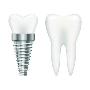 Tooth implant vector design illustration isolated on white background
