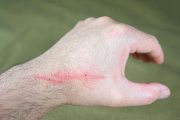 two scratch on man crossed arms closeup