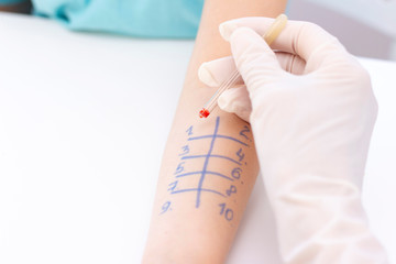 Allergen test on hand. child undergoing procedure of allergen skin test in clinic.