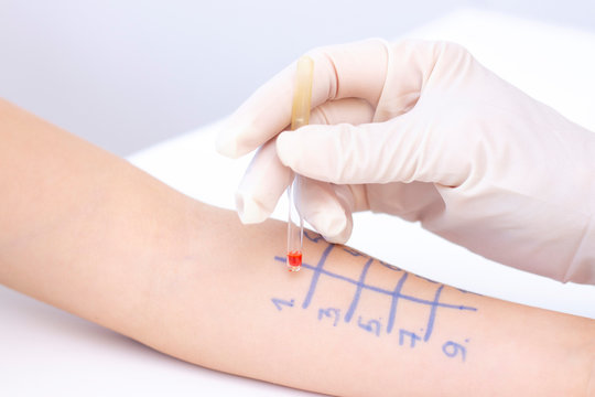 Allergen Test On Hand. Child Undergoing Procedure Of Allergen Skin Test In Clinic.