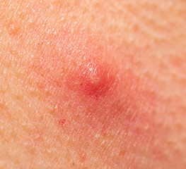 Fototapeta premium red acne on the face