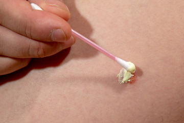 inflammation of the skin, the use of ointments for treatment