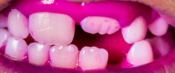 Plaque on teeth colored pink and purple.