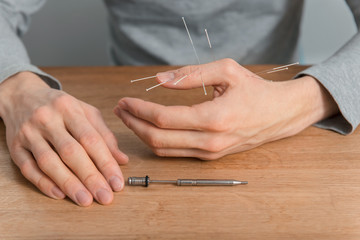 Man using acupuncture treatment for pain relief