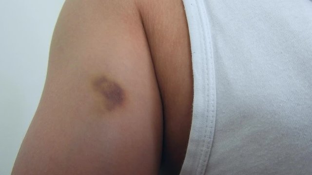 Bruises formed on the arm,
bruises on the skin as a result of a blow
