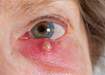 Gerstenkorn am Auge