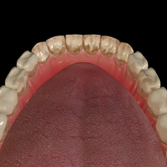3d Illustration of the Teeth Tartar