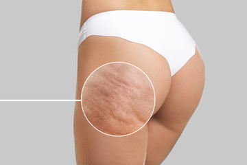 Young woman with cellulite problem on light background - obrazy, fototapety, plakaty