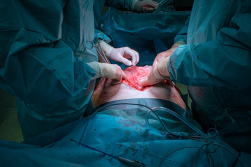 a surgical team performs a surgical abdominal operation
