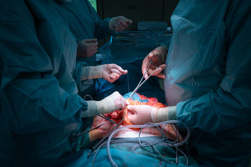 a surgical team performs a surgical abdominal operation