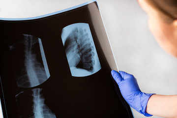 Female doctor examining X-ray film (scan) thoracic. Concept of medical service, diagnosis and treatment. Scoliosis or osteochondrosis detection test. Copy space for text - obrazy, fototapety, plakaty