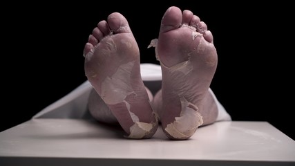 Fototapeta premium Pathologist in black gloves hangs blank white tag on foot of corpse. legs of girl or guy who died from illness are in morgue under white blanket. Dry pilled skin on the feet.