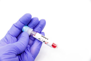 Obraz premium Closeup of microbiologist or medical worker hand with blue surgical gloves marking blood test result as positive for the gout. Gout Positive concept