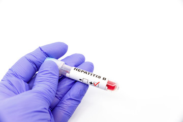 Obraz premium Closeup of microbiologist or medical worker hand with blue surgical gloves marking blood test result as positive for the hepatitis B. Hepatitis B Positive concept