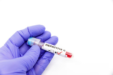 Naklejka premium Closeup of microbiologist or medical worker hand with blue surgical gloves marking blood test result as positive for the hepatitis C. Hepatitis C Positive concept