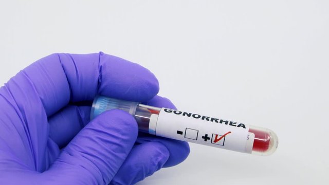 Closeup of microbiologist or medical worker hand with blue surgical gloves marking blood test result as positive for the gonorrhea. Gonorrhea Positive concept