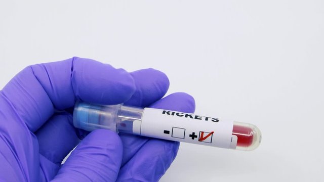 Closeup of microbiologist or medical worker hand with blue surgical gloves marking blood test result as positive for the rickets. Rickets Positive concept