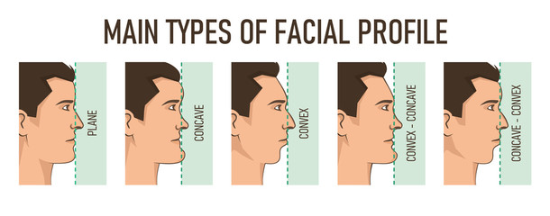 Main types of facial profile - convex, concave, plane.