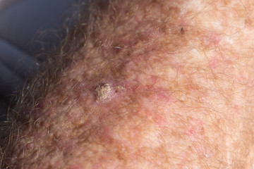 Fototapeta premium SCC skin cancer on senior male arm