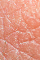 macro photo of dry human skin after frequent washing hands with soap