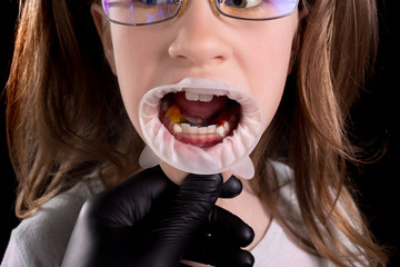 The doctor examines the child's teeth. A child with crooked teeth.