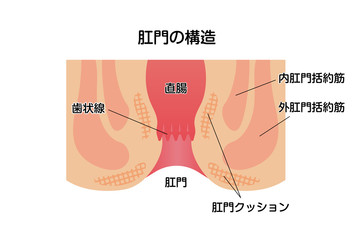 痔のタイプ・種類 (肛門断面図イラスト)