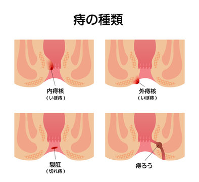 21 BEST 外痔核 IMAGES, STOCK PHOTOS u0026 VECTORS  Adobe Stock
