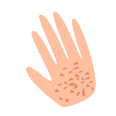 Freckles on the hand. Pigmentation on the skin. A pigmented spot on the skin of the hand. Vector illustration