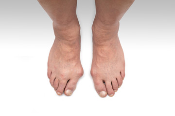 Varus valgus and Hallux valgus, bunion on white background.