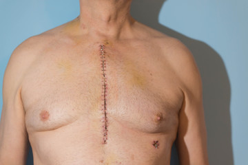 Fototapeta na wymiar Klatka piersiowa mężczyzny po operacji bypass.