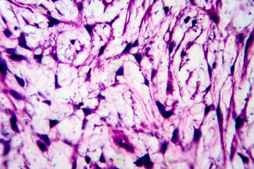 Obraz premium Uterine cancer, light micrograph
