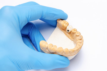 a gloved hand holds a plaster model of the lower jaw with a ceramic crown on a dental implant....