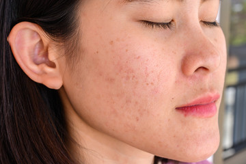Side view close-up of woman face has variety problems on her skin (such as Acne, Pimple, Pores and...