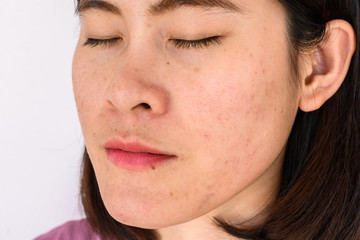Side view close-up of woman face has variety problems on her skin (such as Acne, Pimple, Pores and Melasma etc). Conceptual of natural problem on woman skin.