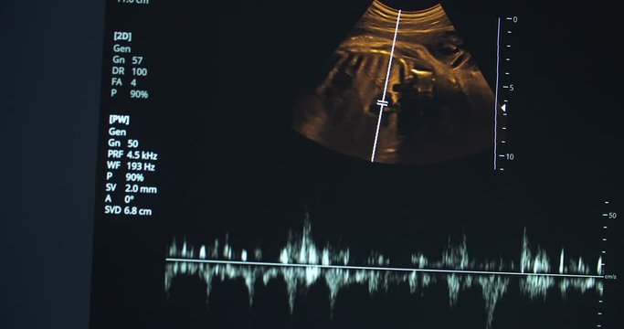 Sonography or medical ultrasound examination of a 36-week-old fetus. Heartbeat visualization.