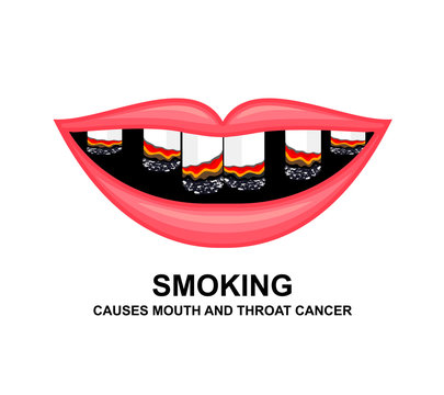 Cigarette in human mouth. Smoking causes damage to the teeth. World no tobacco day. Vector illustration isolated on white background.