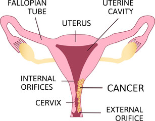 Cervical Cancer. Carcinoma of Cervix. Malignant neoplasm arising from cells in the cervix uteri. - obrazy, fototapety, plakaty