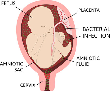 Cervical Weakness. Prolapse Of The Amniotic Sac, Leaking Amniotic Fluid,  Premature Rupture Of Membranes. Fetus In Uterus, Womb, Placenta, Umbilical  Cord. Hi-risk Pregnancy Complications, Insufficiency, Incompetent,  Incompetence Stock Photo, Picture and ...