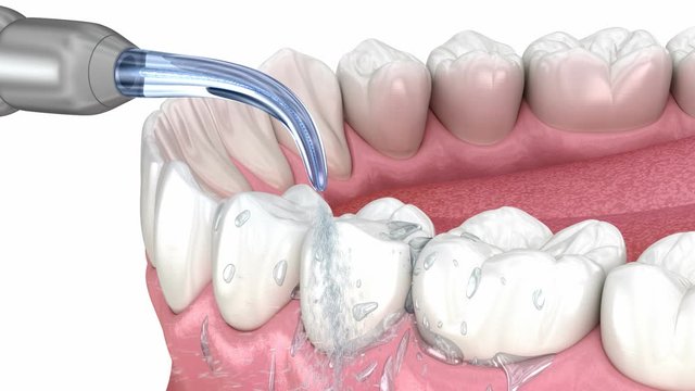 Irrigator, Water teeth cleaning. Medically accurate 3D animation of oral hygiene.