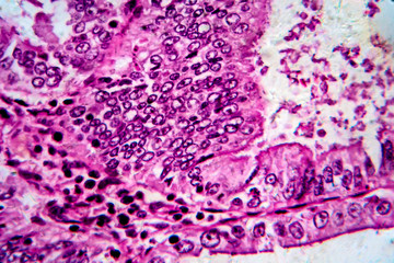Endometrial adenocarcinoma, light micrograph, photo under microscope