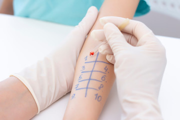 Allergen test on hand. child undergoing procedure of allergen skin test in clinic.