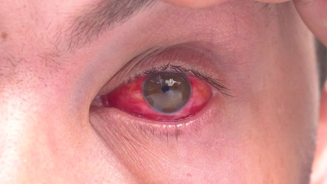 Close up of two annoyed red blood eyes of male affected by conjunctivitis or after flu, cold, allergy. Red eye. damaged eye. Blood in the eye. Eyes close up. Sore eye. Mschina with a sore eye